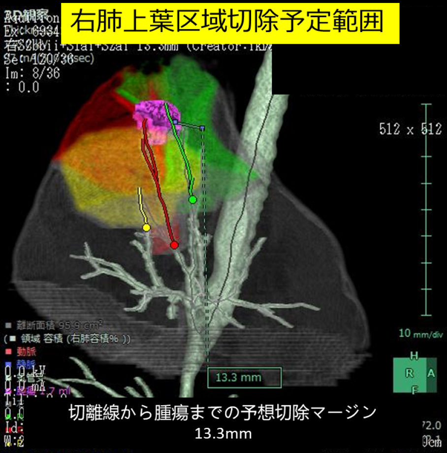 右肺上葉区域切除予定範囲画像