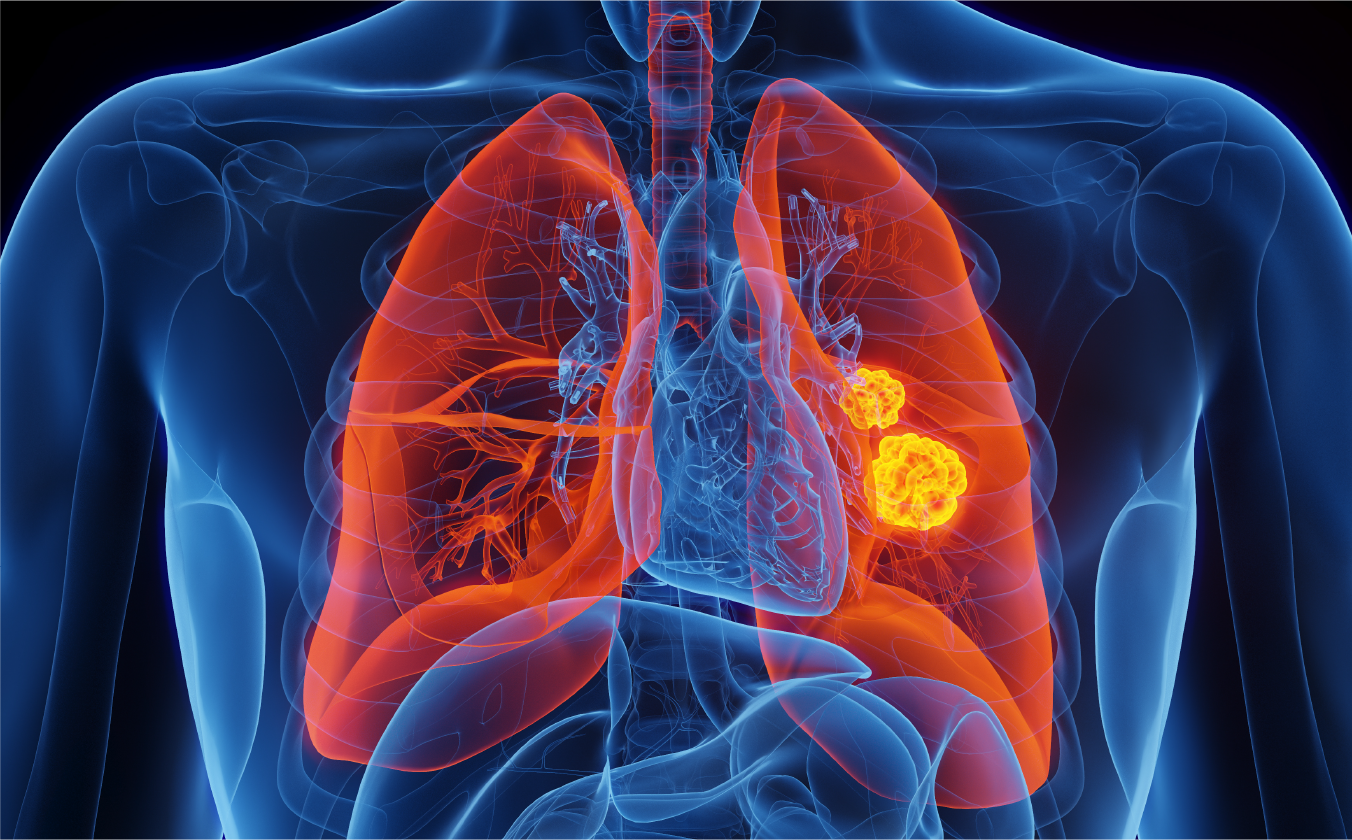 原発性肺癌の画像